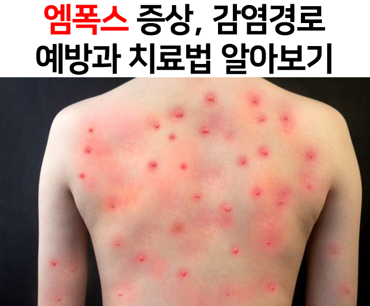  엠폭스(원숭이두창) 증상, 감염경로, 예방과 치료