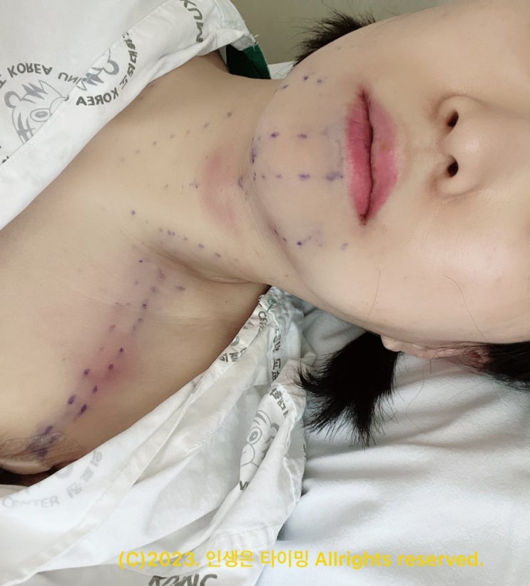  [ 갑상선암 로봇수술 후기 ] 고대안암 로봇수술후 12시간 이내 붓기비교