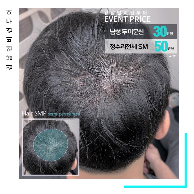  두피문신가격 여성탈모 컴플렉스 지우고 싶다면