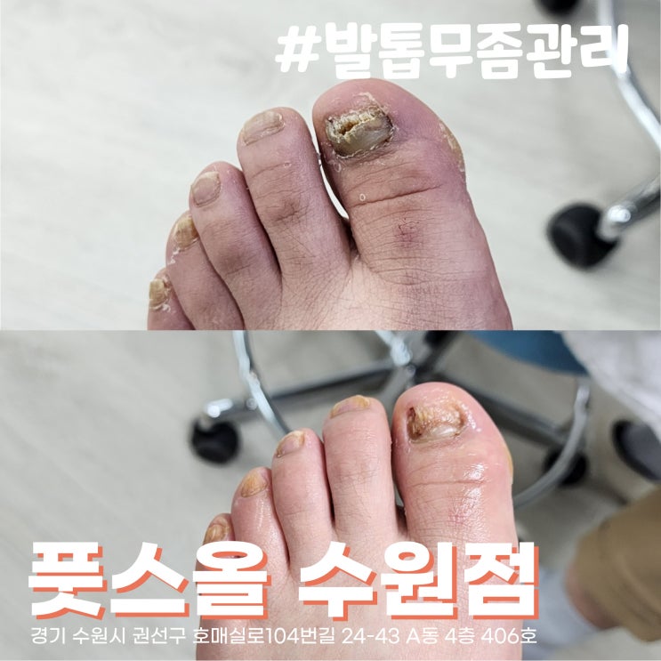  [수원/호매실] 무좀발톱관리 풋스올 수원점, 친절한 원장님때문에 20년만에 치료 결심!