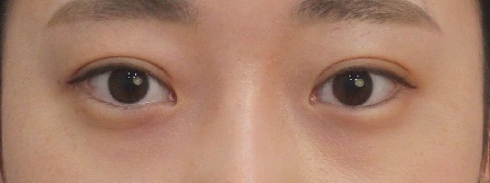 (신사역, 루비성형외과)-짝눈 성형 쌍꺼풀 수술로 교정 성공