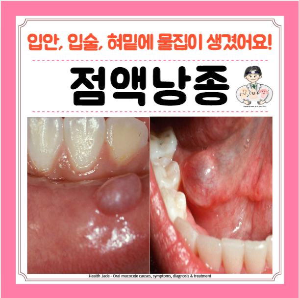  입안 입술 혀밑 물집 점액낭종 하마종 원인 증상 치료 수술