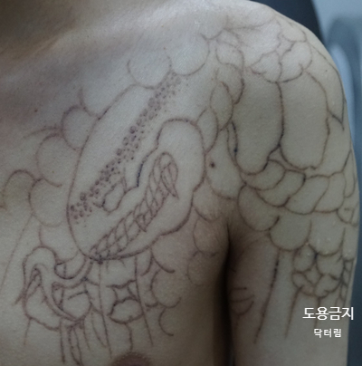  [삼성중앙역 피부과] 문신제거 피코레이저 (part 3) - 전신 그림 문신 치료 효과, 전후 비교 - 피부과전문의 닥터림
