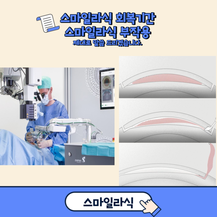 스마일라식 회복기간 정확히 알고 수술하세요