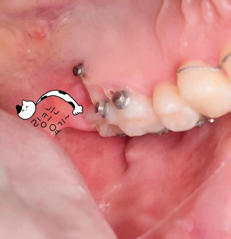 [고우넷 치과후기] 치과방문 15번째 일기, 교정 287일차 / 언제..아랫니해요.. 고무줄 위치바꾸다