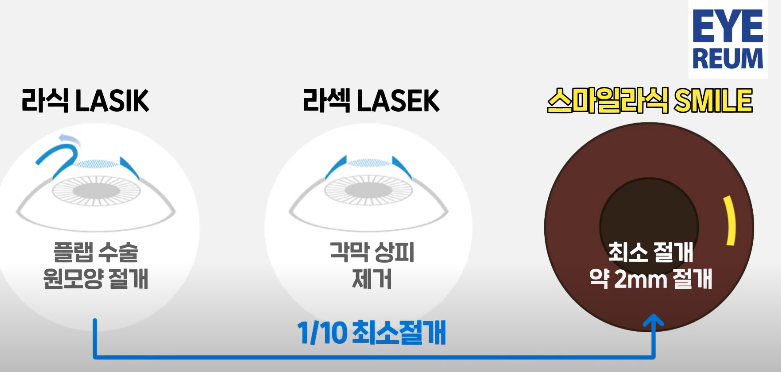 웃음각막이 두꺼우면 모든 수술이 가능한가요?
