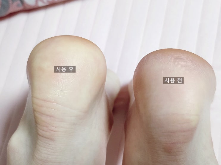  발각질제거기 보카스 사용 후기! 뒷꿈치 거친 발바닥굳은살제거기