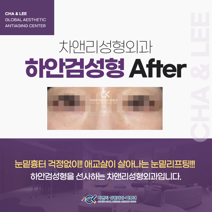  눈밑 아이백 고민해결 하안검성형 일산파주김포성형외과