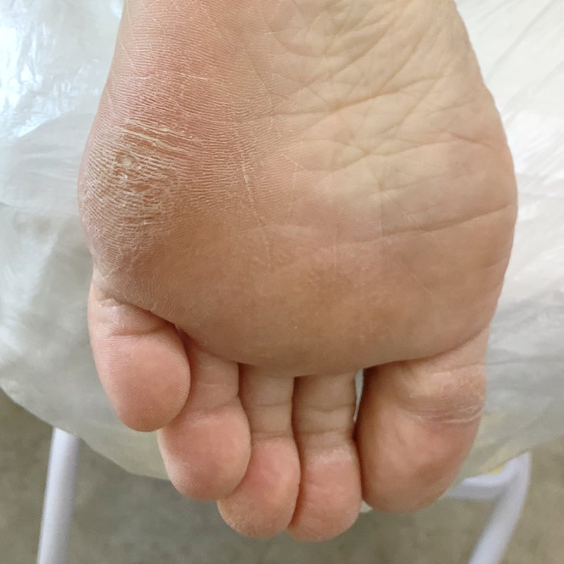 공덕 발바닥 사이드 딱딱한 굳은살 통증 발날로 걷는다면 주목!