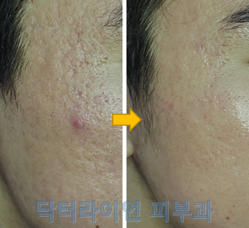 왕십리 피부과 피코 프락셀 레이저 | 마스크 착용으로 커진 코 모공과 여드름 흉터 치료에! 4