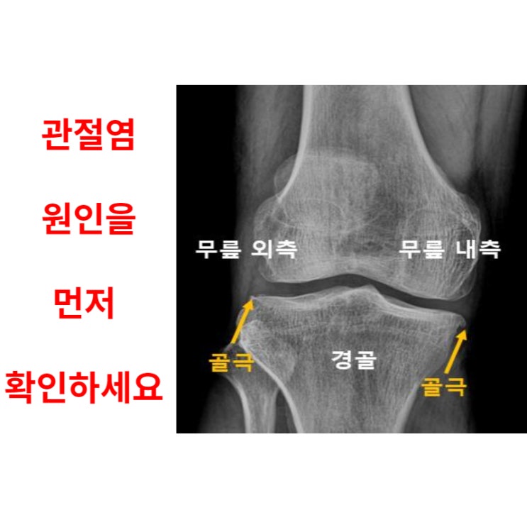  광주 퇴행성 무릎 관절염, 원인을 먼저 확인하세요