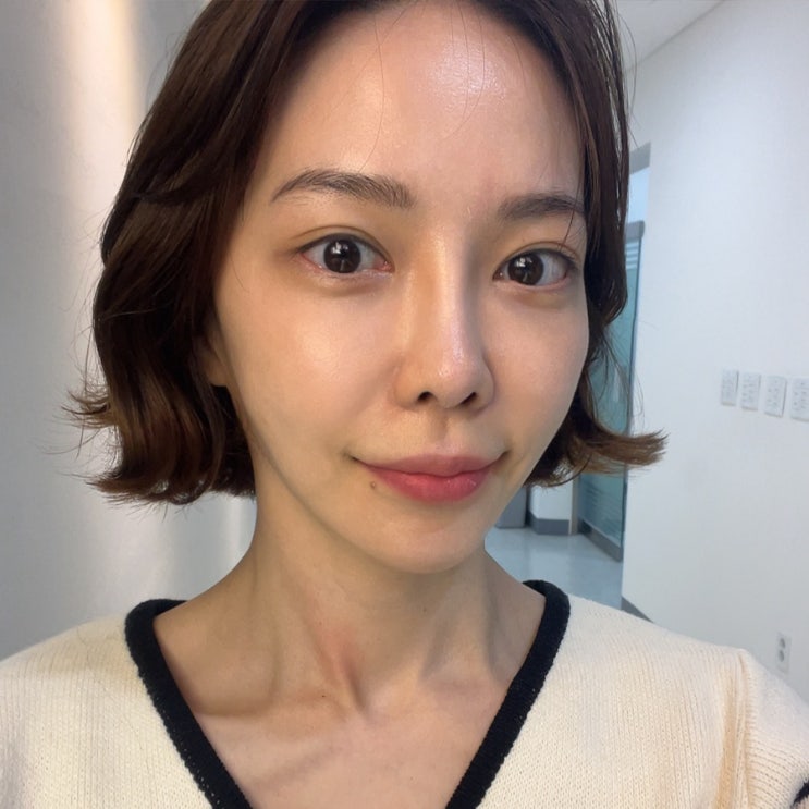  앞볼필러 명동피부과에서 받아 본 내돈내산 1개월차 솔직 후기
