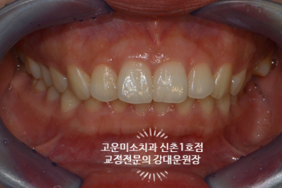  윗니돌출 가위교합 무턱 뚱한입술 호두주름 과개교합을 동반한 2급부정교합치료 신촌 교정전문의 강대운원장 고운미소 신촌1호점 치료증례