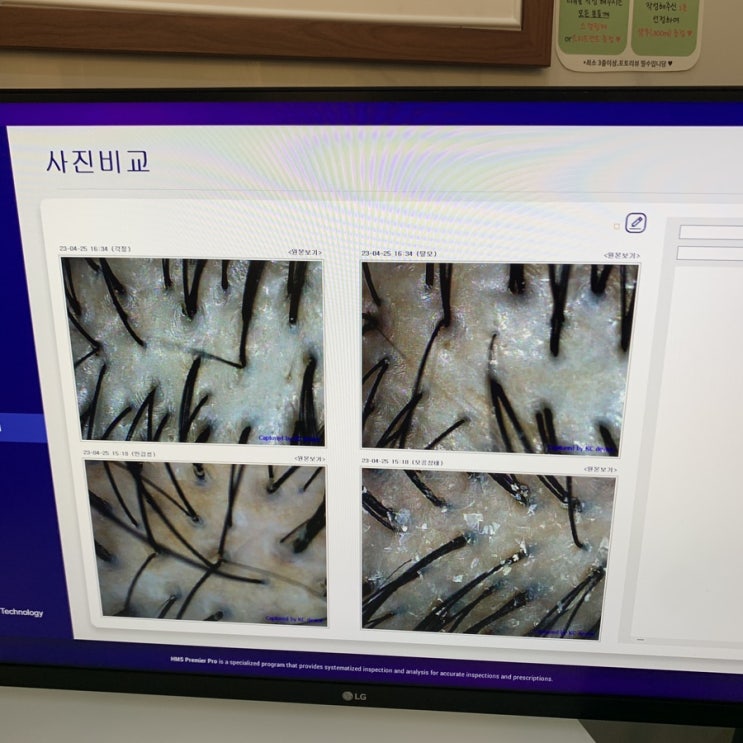  광교두피관리 닥터모락 광교중앙역점에서 데톡스케어 관리 후기
