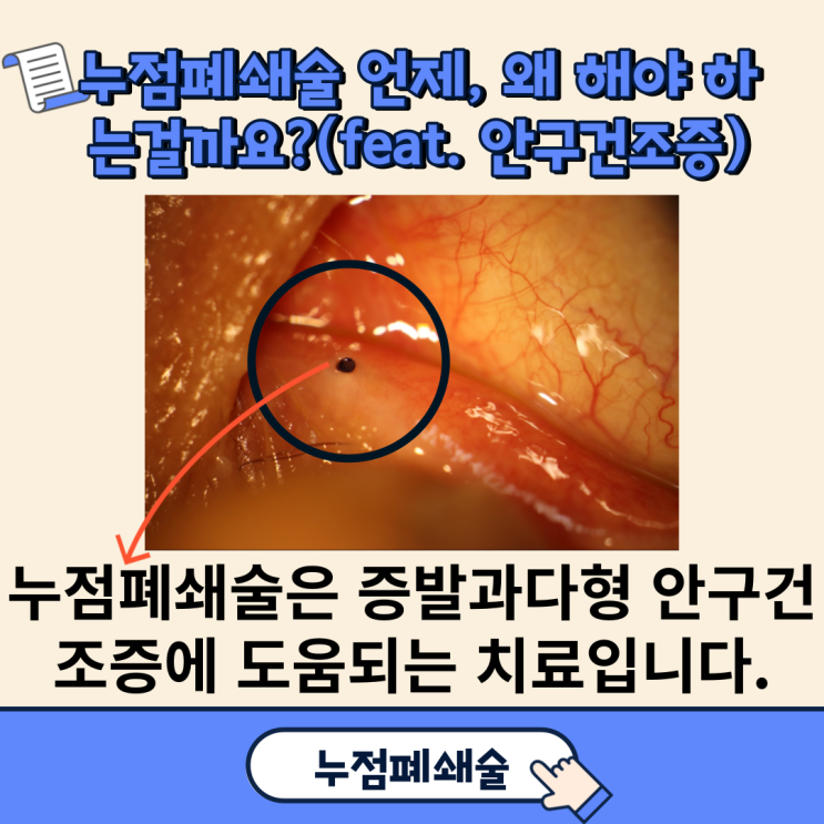  누점폐쇄술 언제, 왜 해야 하는 걸까요?(feat. 안구건조증)