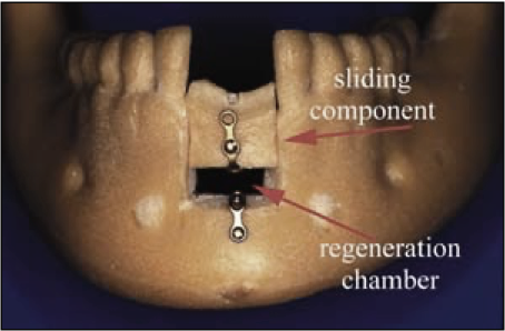 골유착된 치아의 교정적 견인 - Segmental Distraction Osteogenesis (분절 치조골 신장술) (2)