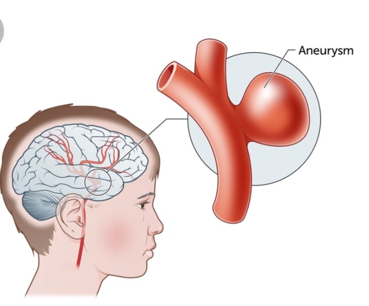 NS수술실 간호사 - . 신경외과 필수 기본 의학용어 정리 3 aneurysm clipping