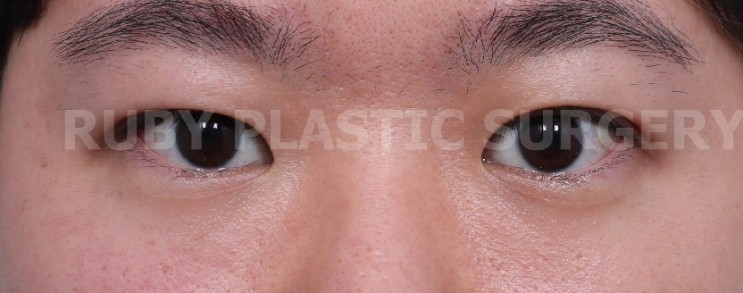 남자 무쌍 눈매교정 한 달 된 후기 - 강남 루비 성형외과(+비용, 가격)