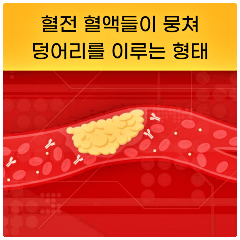 혈전용해제 종류 효능 부작용 : 네이버 블로그