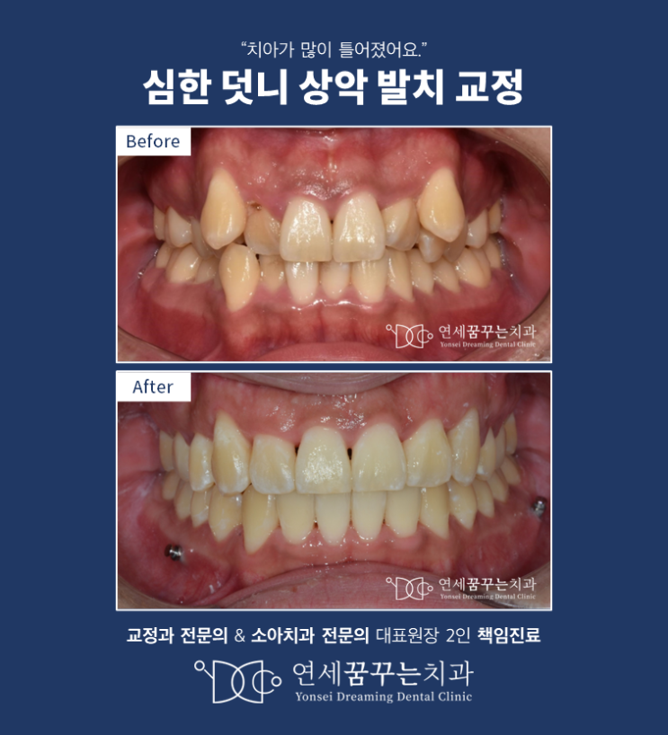 하남에서 올바른 방법으로 덧니를 교정하는 방법