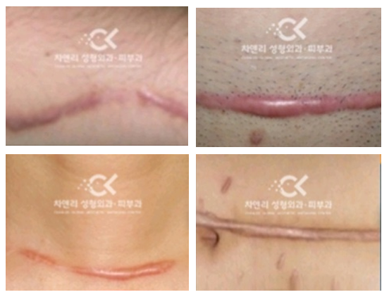  비대성 흉터 제거치료는?