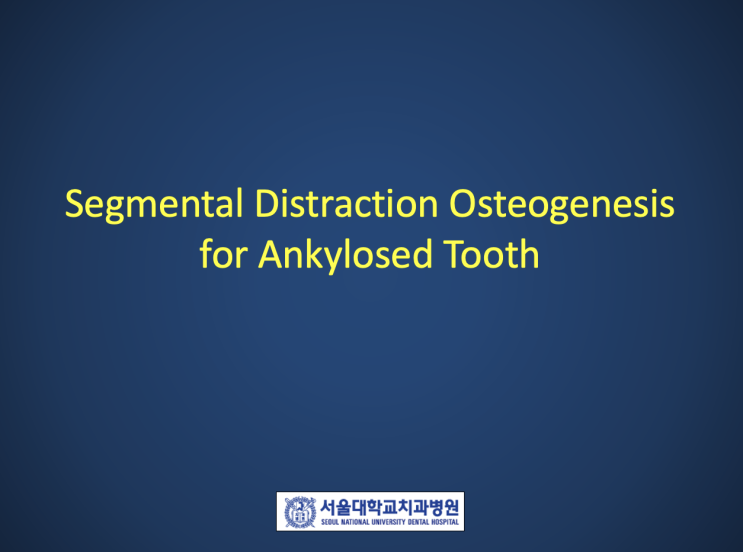골유착된 치아의 교정적 견인 - Segmental Distraction Osteogenesis (분절 치조골 신장술) (1)