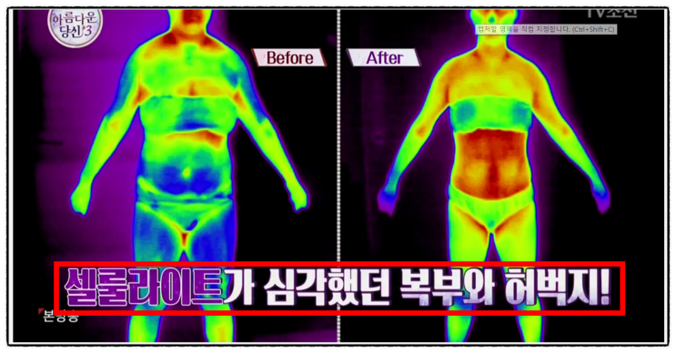  셀룰라이트 제거, 허벅지, 엉덩이 종아리 셀룰라이트(날씬해도 울퉁불퉁한 살을 잡아라)
