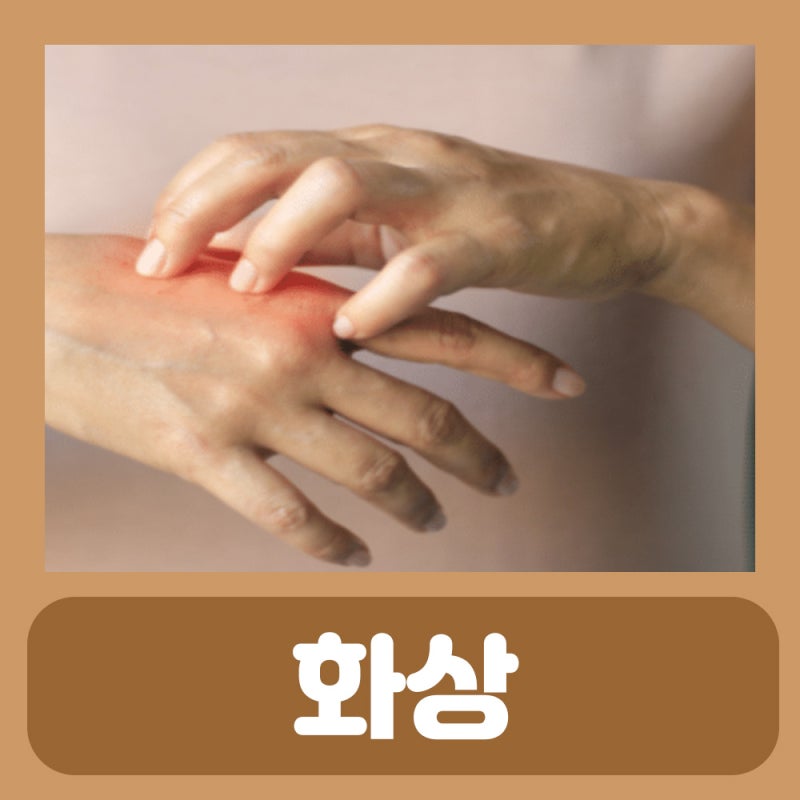 화상메디폼 : 기름 고데기 뜨거운물 화상 표재성 심재성 2도 화상 1도 2도 3도 화상 입었을때 연고 치료 흉터 통증, 얼굴 ...