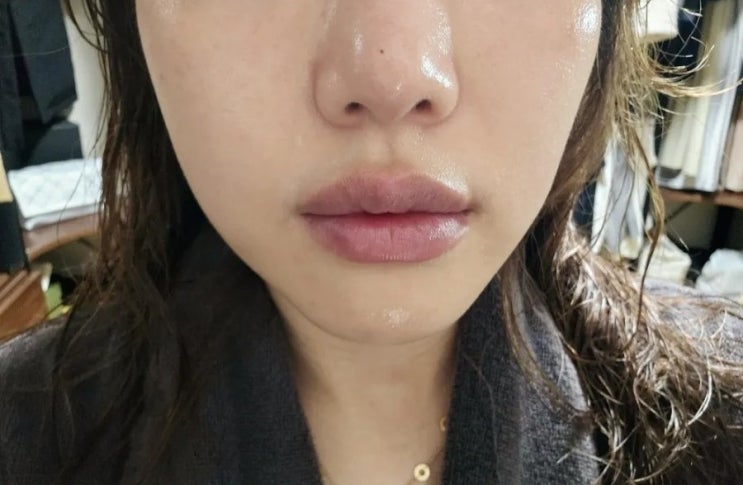 인천 구월동 피부과 통증 적은 리쥬란 더마샤인 솔직후기 인천 구월동 피부과 통증 적은 리쥬란 더마샤인 솔직후기