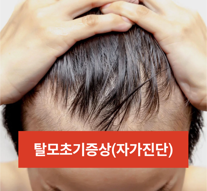 M자형 탈모의 초기 증상을 단계별로 정리해보자 4