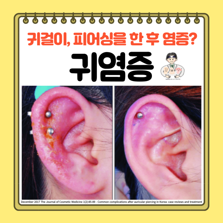  귀걸이 귓바퀴 피어싱 귀 뚫고 염증 냄새 약 연고