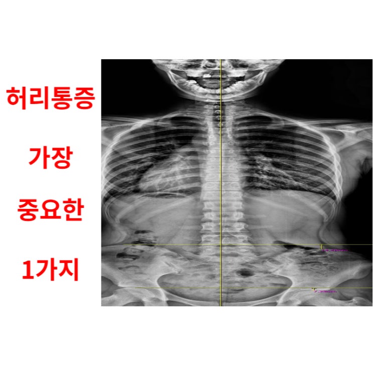  광주허리통증, 가장 중요한 1가지 체크하세요