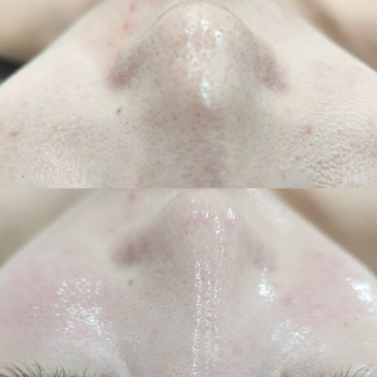  보라매 피부관리 리본에스테틱에서 깐달걀피부로 재탄생(모공, 요철 효과)