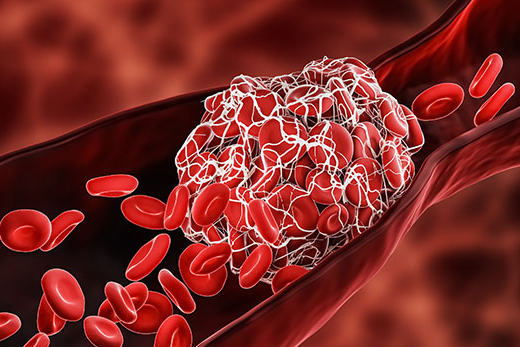 뇌줄중과 심장마비의 위험을  확 줄여주는 혈전 녹이는 방법