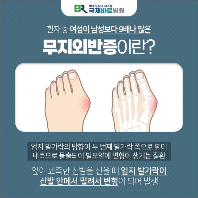 발가락 성형외과 다가오는 여름 무서워요?