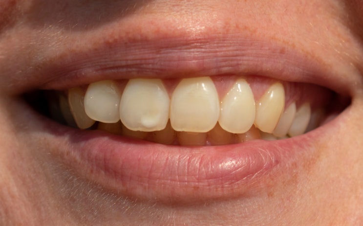 치아 하얀반점, 하얀 충치도 있다고? (치료방법)