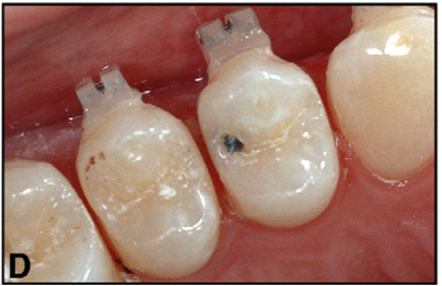 치간삭제, 스트리핑, Stripping, IPR (InterProximal Reduction) - 비발치 치아교정에 종종 필요한 이것은?