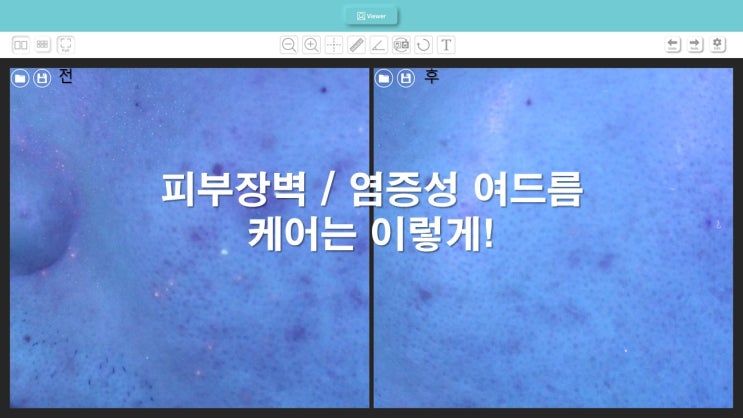  광주 여드름 압출 피부 타입별로 제대로 받자!