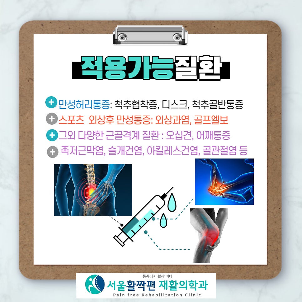 인대강화로 통증 치료 하는 프롤로테라피 — 본문 그림