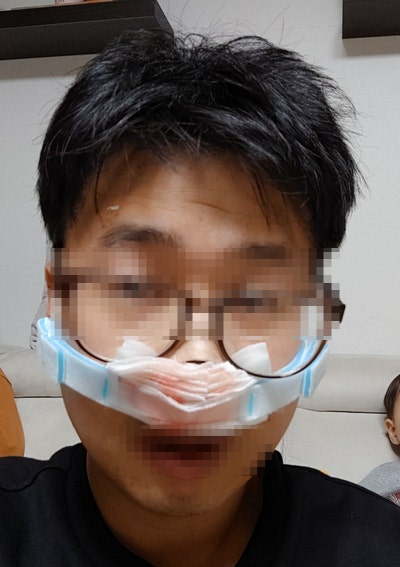 코 골절 수술-1[비관혈적 정복술]