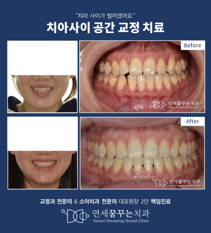 치아 사이가 벌이진 부정교합(치아 사이 공간)을 갖는 성인에서 할 수 있는 교정치료