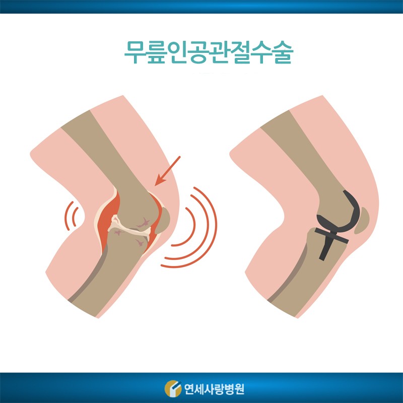 무릎 인공관절 수술을 잘하는 곳에서 개발한 한국형 맞춤형 인공관절