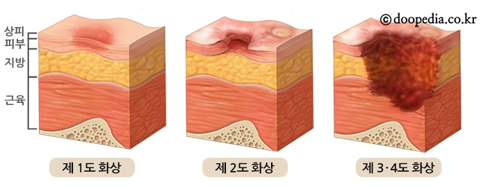 약사쌤이 알려주는 화상시 응급처치와 화상연고 : 네이버 블로그