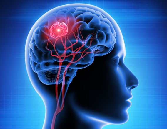 생존률 낮은, 뇌종양의 원인과 증상 치료방법은?