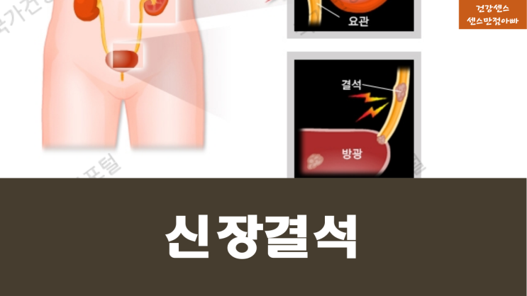  신장결석(요로결석) 정의 발생가능성 높은사람 및 증상 원인:검사 치료방법 예방법 알아보기
