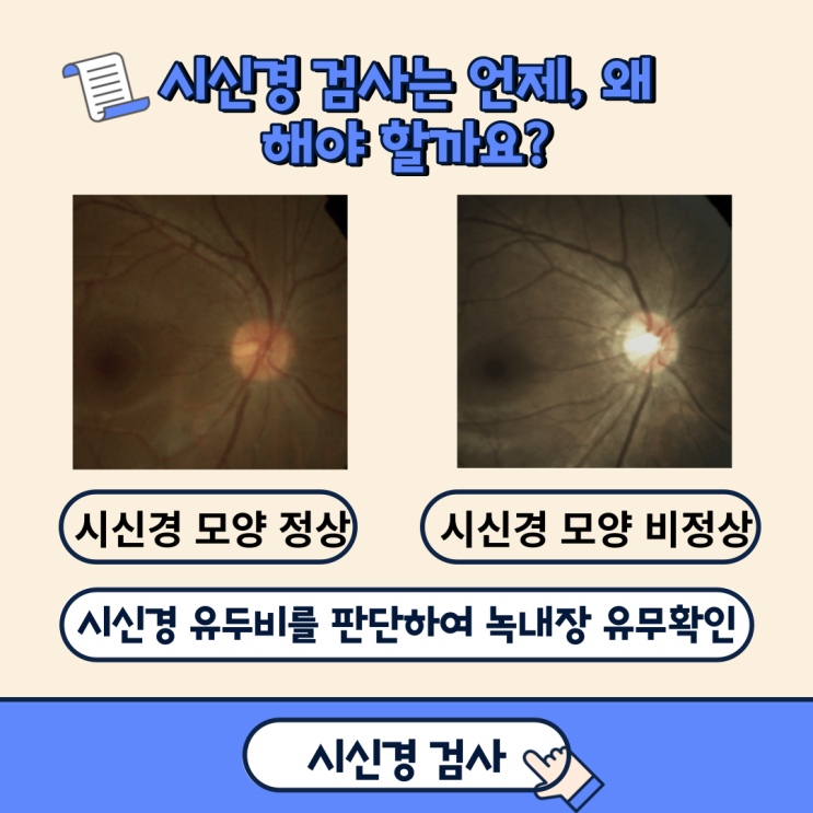  시신경 검사의 중요성(feat.녹내장 원인)
