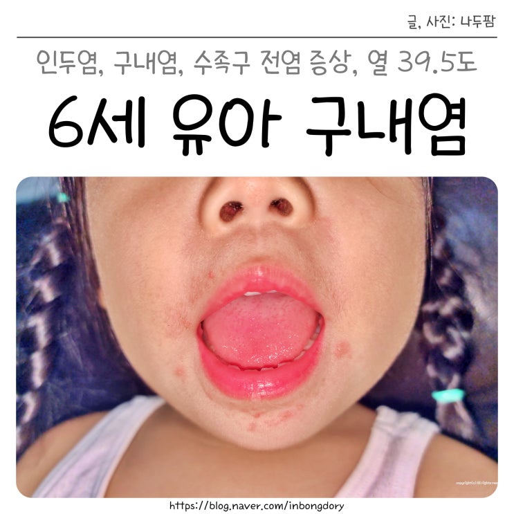  6세 유아 구내염 전염 증상, 열 39.5도