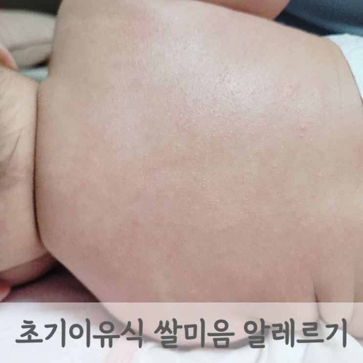  초기 이유식 쌀미음 알레르기 쌀가루 두드러기 반응