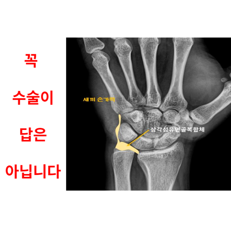  손목삼각섬유연골 파열, 수술이 답은 아닙니다