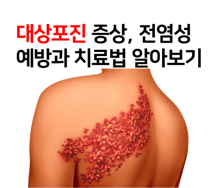  대상포진 증상, 전염성, 예방과 치료법 알아보기